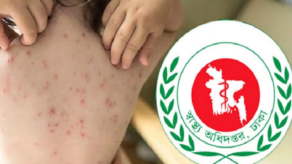 হাম উপসর্গে আরও ৩ জনের মৃত্যু