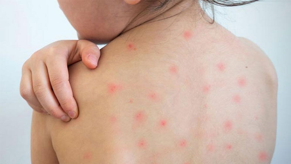 ২৪ ঘণ্টায় হামের উপসর্গ নিয়ে ৪ জনের মৃত্যু