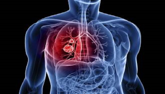 <font style=\'color:#000000\'>Lung cancer now deadlier than breast cancer in rich nations</font>