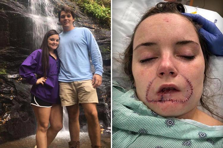 Student's lip bitten off by her ex, he wanted to 'leave his mark'