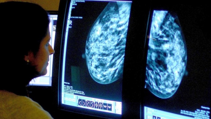 Women at risk of breast cancer ‘should be screened in their thirties’