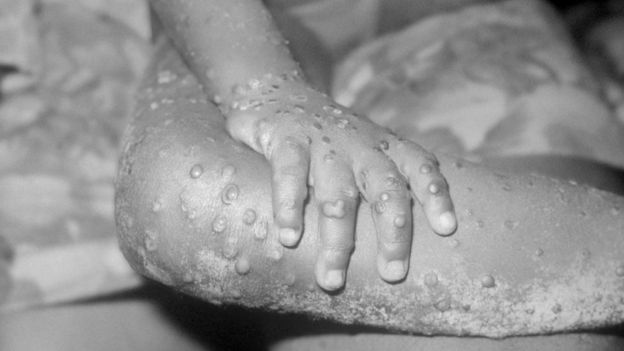 UK patient diagnosed with monkeypox