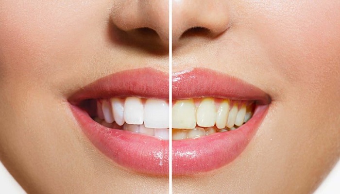 Want white teeth? Try these home remedies