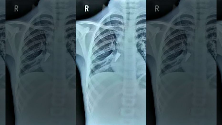 Pen cap removed from lungs, 12-year-old Kolkata boy gets new life