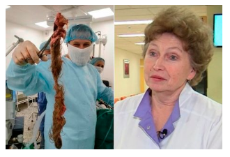 Doctors remove huge hairball growing inside 30-year-old woman's ovaries