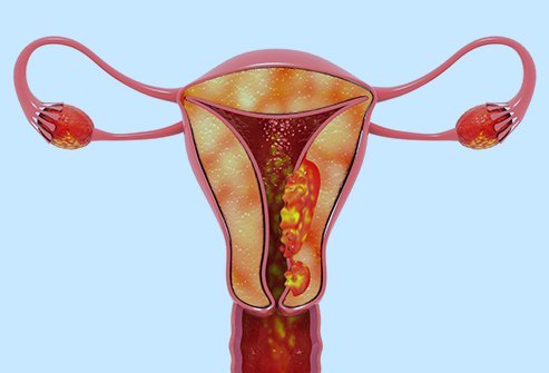 Proper education on reproductive health curbs uterus cancer