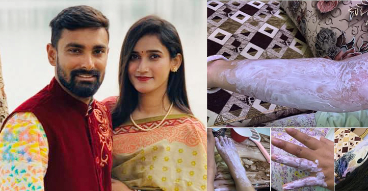 Liton Das’s wife sustains burns in gas cylinder blast