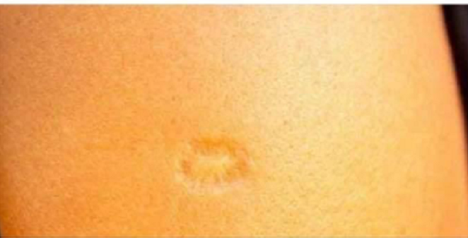 Coronavirus: BCG rumours and other stories fact-checked