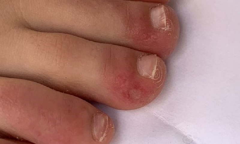 Coronavirus: 'Covid toe' and other rashes puzzle doctors