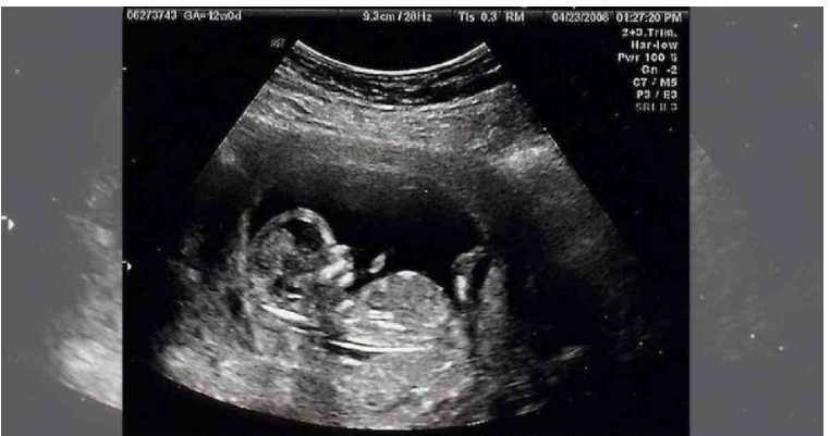 Ultrasound tests during childbirth 'reduces infections'