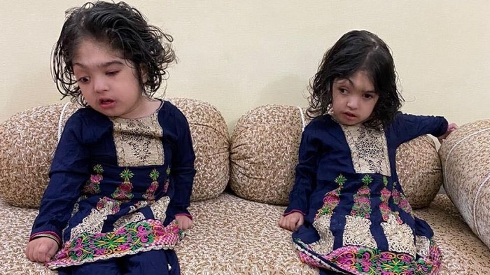 Conjoined twins return home after successful separation