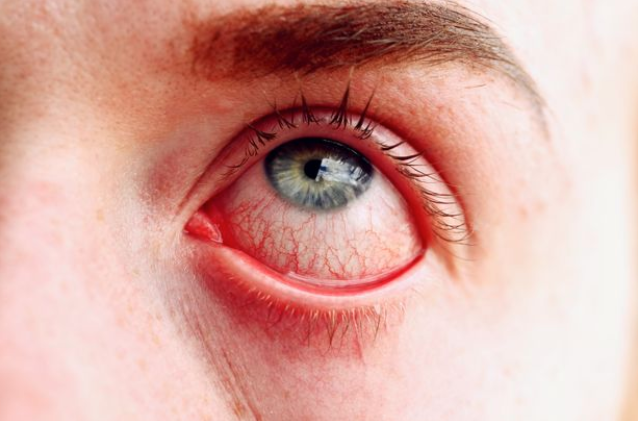 4 mild Covid-19 symptoms you shouldn't ignore including eye infection and 'fog'