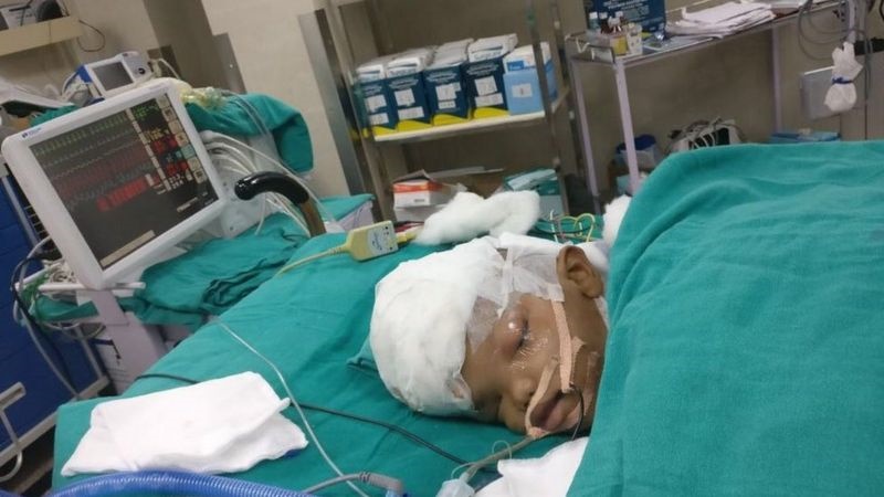 India boy separated from conjoined twin dies after three years