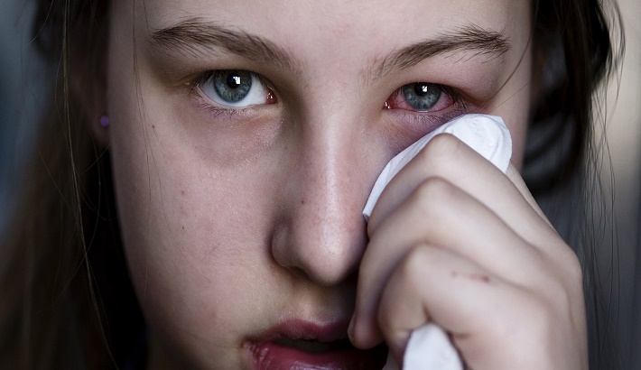 Pink eye or conjunctivitis could be a symptom of COVID 19