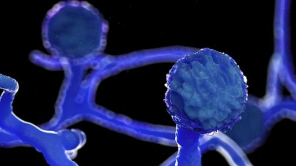 First case of black fungus reported in Chattogram