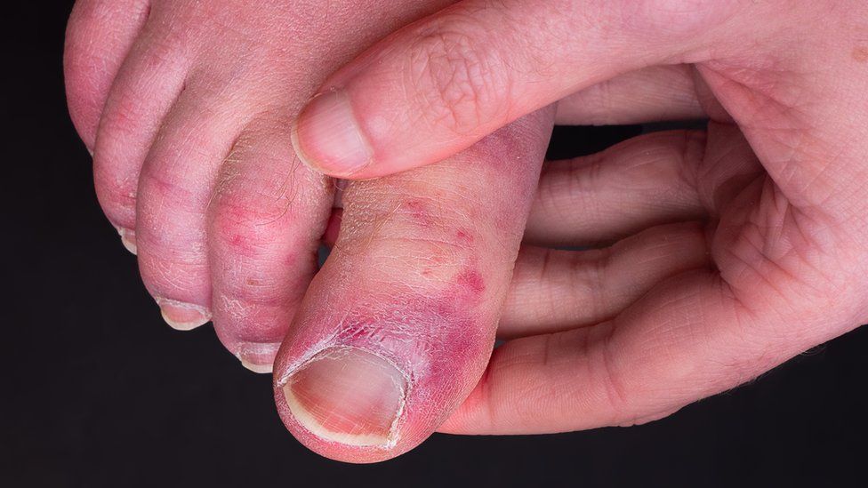Covid toe condition explained by new study