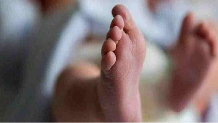 Conjoined twins die hours after birth in Jashore