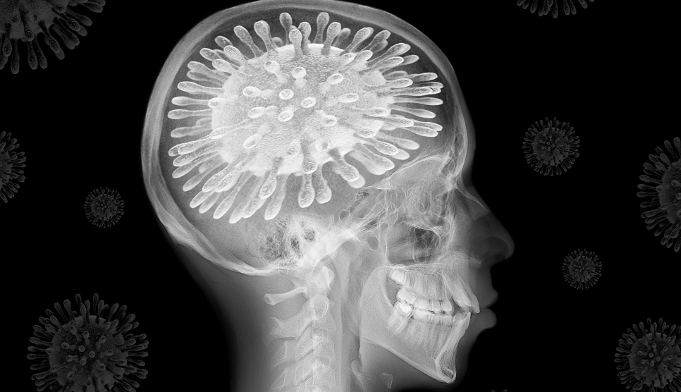 Brain fog associated with long Covid