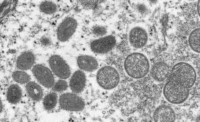 Canada says 15 cases of monkeypox in Quebec, more expected