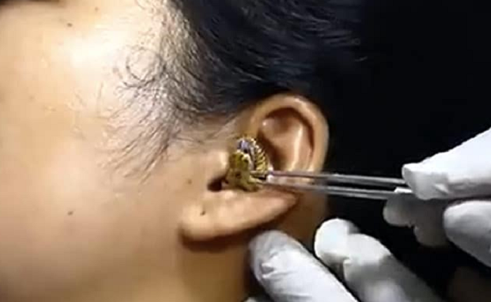 Video: Snake gets stuck in woman's ear