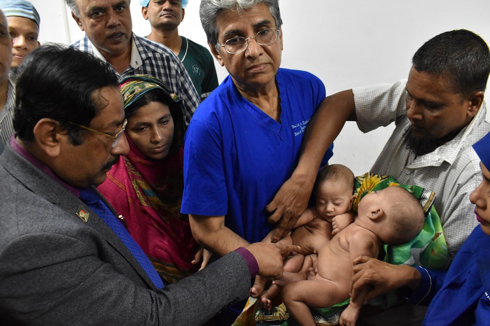 Conjoined babies separated at BSMMU