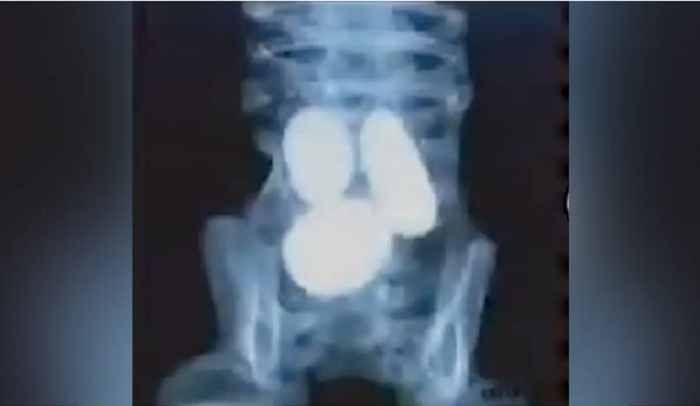 Mexico's 'Alien' bodies analysed, eggs found