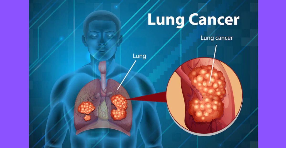 Lung cancer: An overview