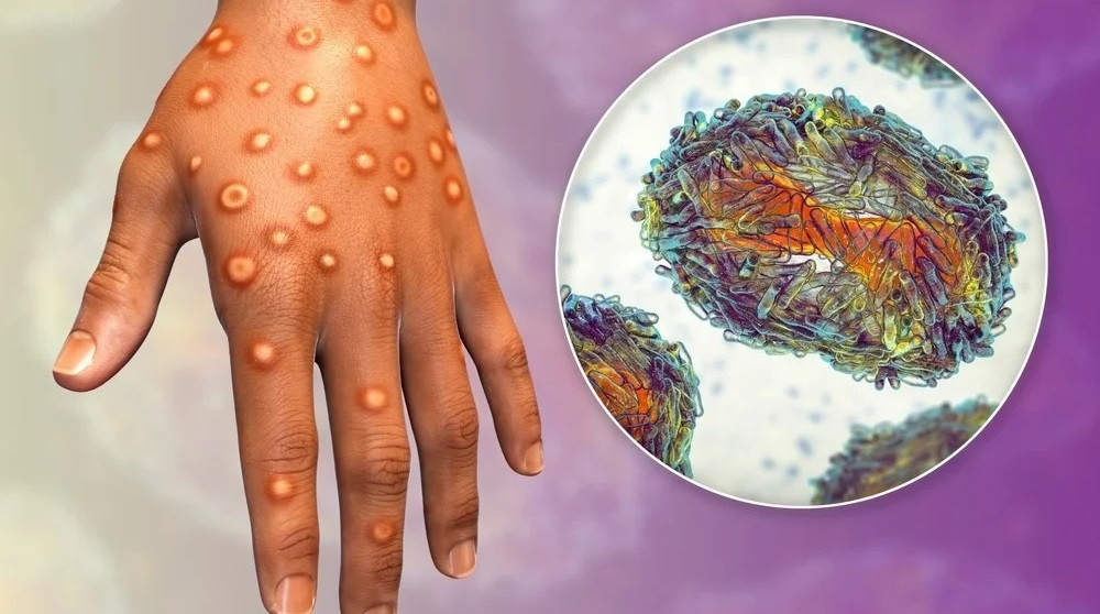 Indian scientists unveil novel insights into Monkeypox virus detection, therapy