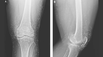 Gold threads in joints found to be cause of woman’s knee pain