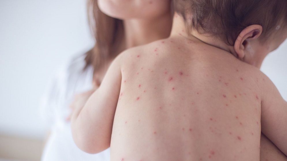 4 more children die from measles symptoms in three divisions