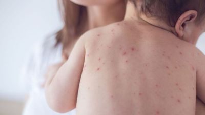 Measles outbreak: Suspected cases cross 1 lakh in Bangladesh