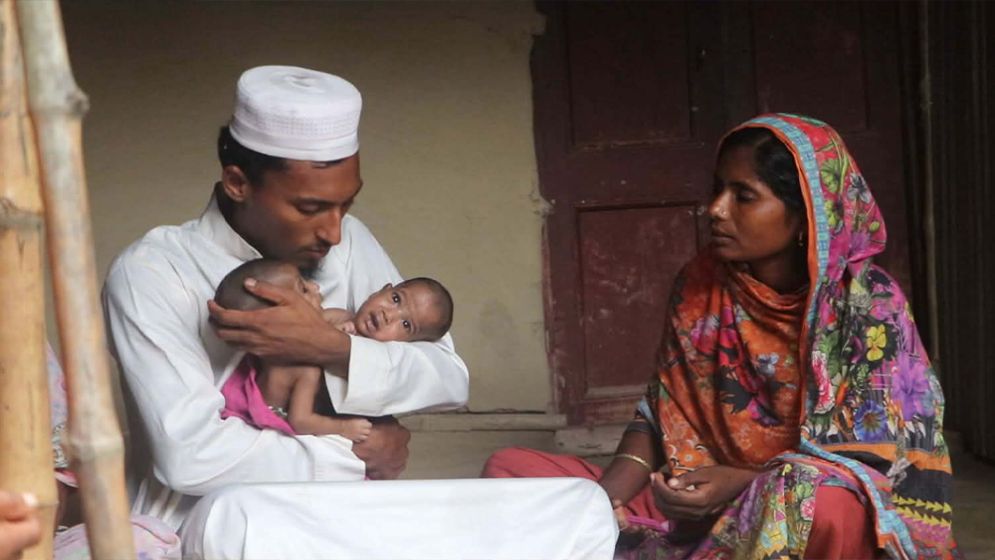 Conjoined twins from Kushtia die at DMCH