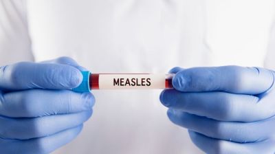 Five more die with measles like symptoms