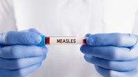 Five more die with measles like symptoms